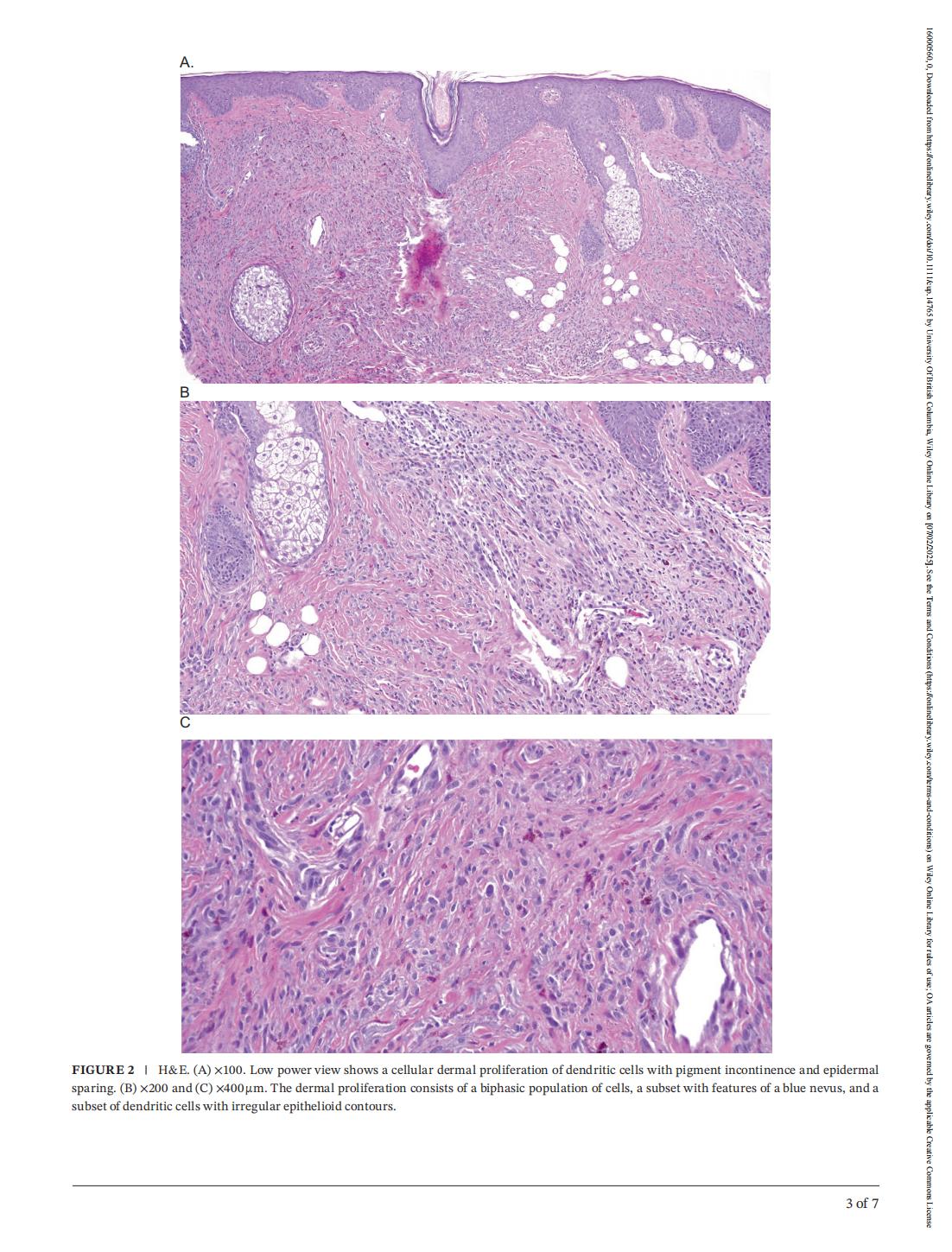 【2025-01-08】J Cutan Pathol - 2025 - Fernandez - Blue Nevus‐Like Metastatic Melanoma in a Patient With Primary Lentigo Maligna Melanoma_02